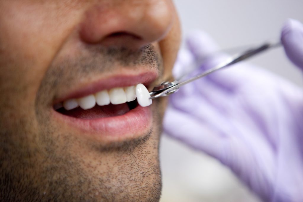 5 tips for porcelain veneers care