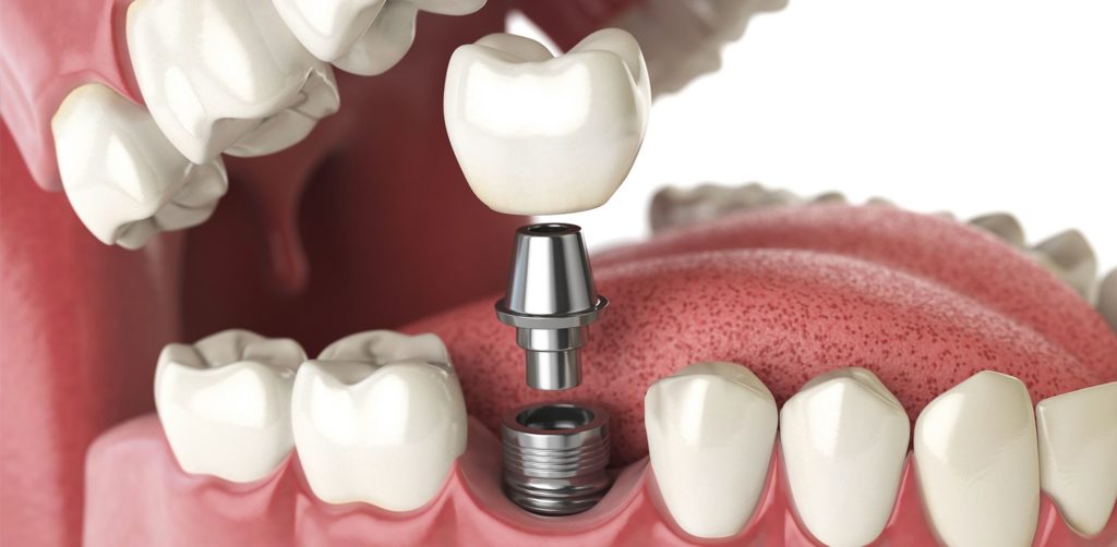 What are the Pros and Cons of Dental Implants